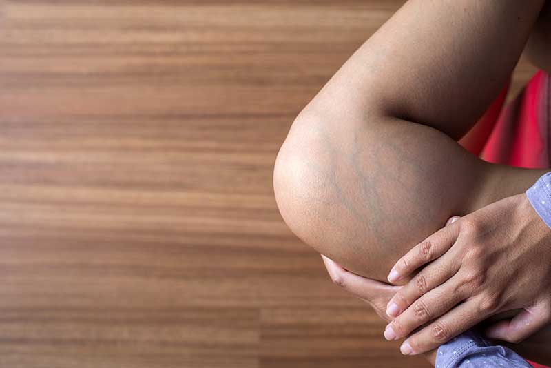 It delays Varicose Veins