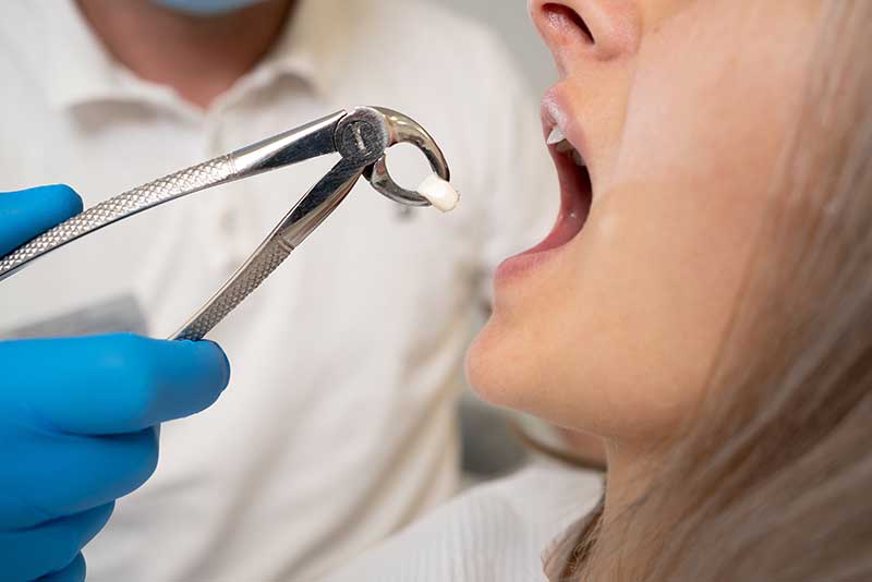 Tooth extraction